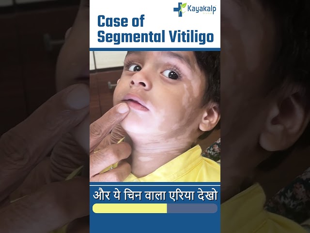 कैसे बढ़ते है सफ़ेद दाग के Recovery के Chances? | Kayakalp Global #shorts #vitiligo #safeddaag