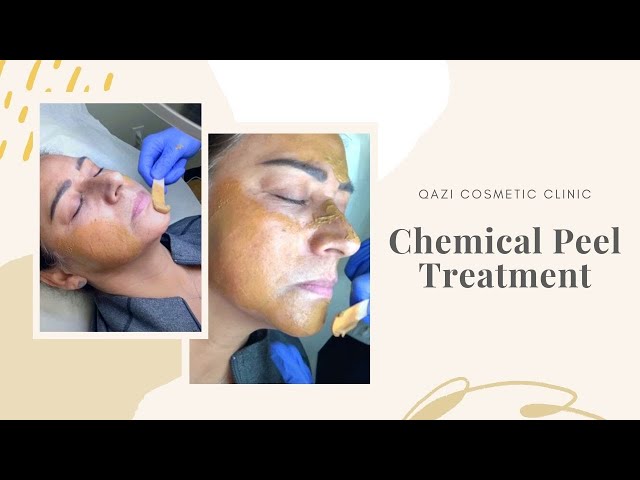 Chemical Peel for Melasma & Sun Spots | Live with Dr. Nadir Qazi