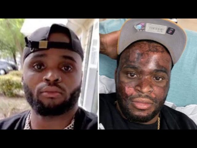 Exclusive | Esthetician Of Viral TikTok Chemical Peel Burn Victim Tells Her Side Of The Story