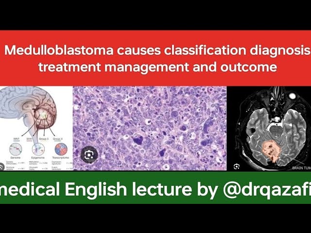 Medulloblastoma causes classification diagnosis treatment management and outcome