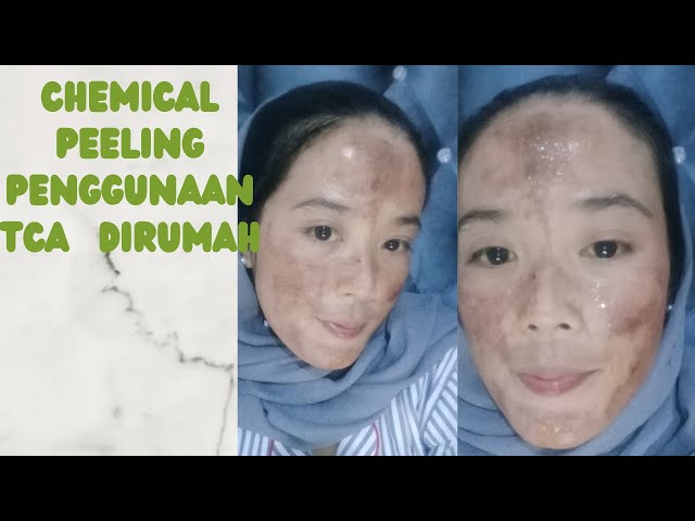 PERUBAHAN  WAJAH  SETELAH CHEMICAL PEELING