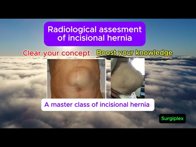 Radiological assessment of incisional hernia - A master class for surgeons & radiologist