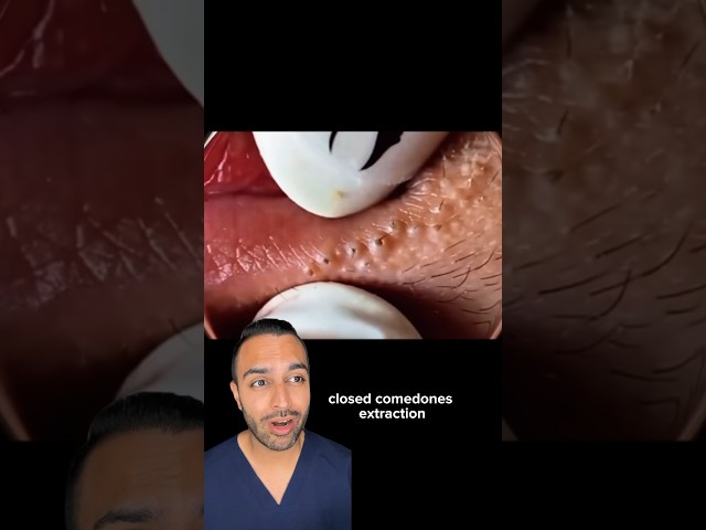 Your lip balm might be causing this! Blackheads removal | Dr Somji reacts