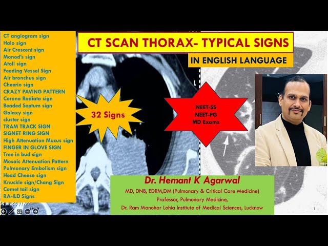 CT SCAN THORAX (ENGLISH) Typical Named Sign for Exams #NEET SS, #NEET-PG @Dr. Hemant K Agarwal