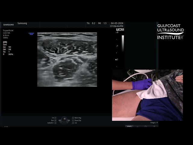 How to Perform an Ultrasound Guided Fascia Iliaca Plane Block