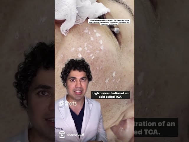 Treating Deep Acne Scars With TCA CROSS Compilation