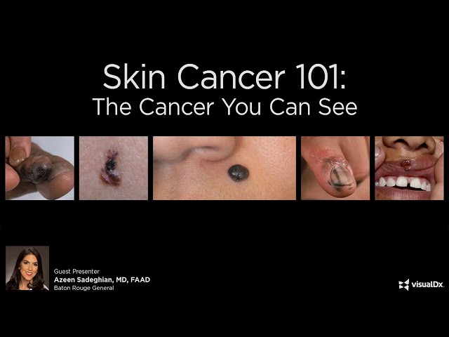 Skin Cancer 101: The Cancer You Can See