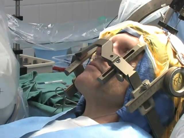 Patient Guide to Deep Brain Stimulation (DBS) Surgery, Mayfield Clinic