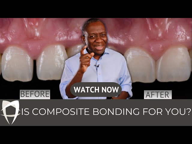 Composite Bonding in London: Miracle Smile Fix or Risky Business? 😮 | The Full Breakdown (2023)