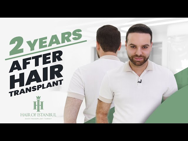 Restoring Confidence with Hair of Istanbul: A Hair Transformation Journey