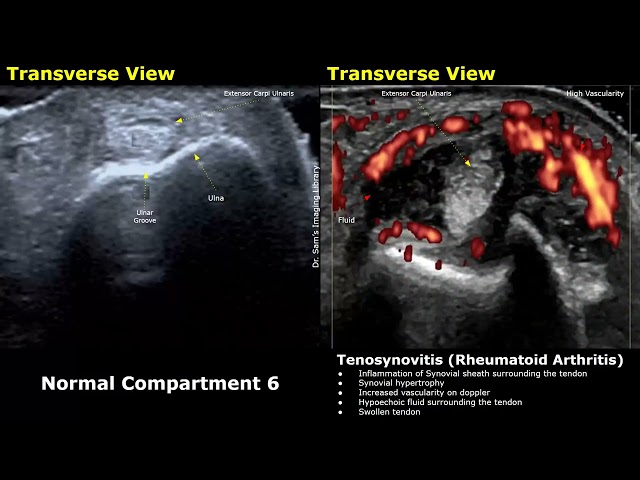 Wrist, Hand & Finger Ultrasound Normal Vs Abnormal Images | Tenosynovitis, Rheumatoid Arthritis USG