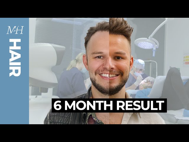 Hair Transplant Results | 6 Months Before and After