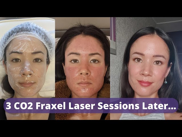 CO2 Fraxel Laser Review 3 Sessions Later - Did My Old Atrophic Acne Scars Improve? | @michxmash