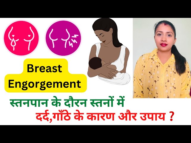 Breast Engorgement Relief in Hindi | स्तनपान के दौरन स्तनों में दर्द,गाँठ | Avoid Clogged Milk Ducts