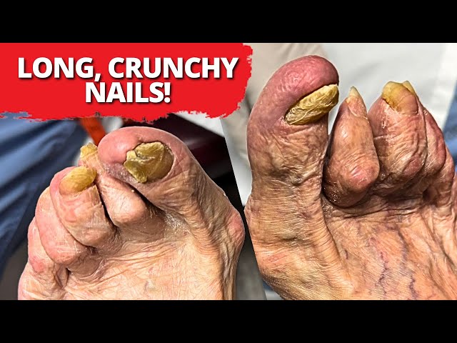 Extreme Nail Cutting Challenge: Sensitive and Tricky Nails!