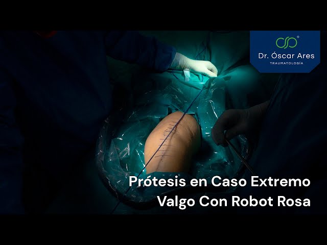 Prótesis en caso extremo - Valgo con Robot Rosa - Dr. Oscar Ares