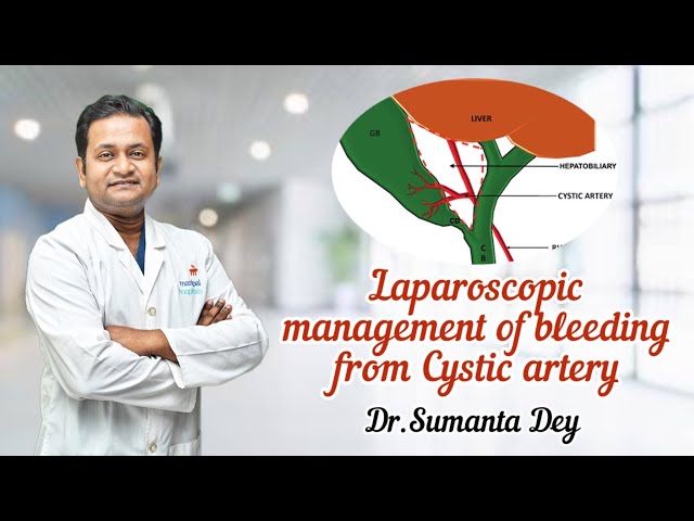 Hemoperitoneum, Bleeding from Cystic artery: Laparoscopic management by Dr.Sumanta Dey