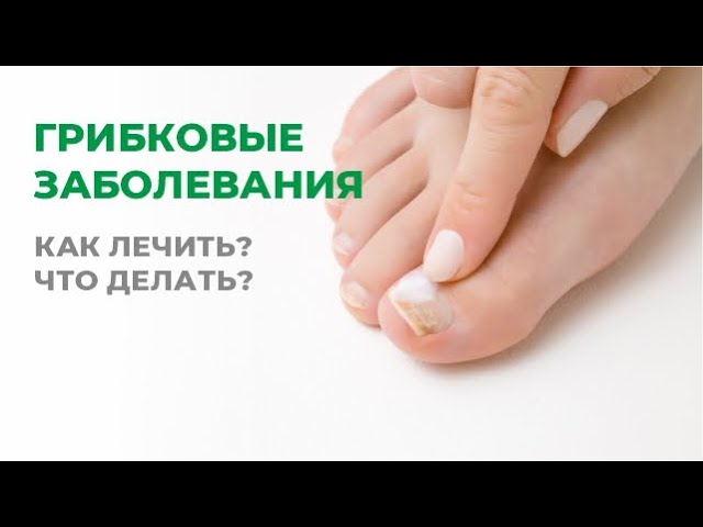 Грибковые заболевания. Как лечить? Что делать?