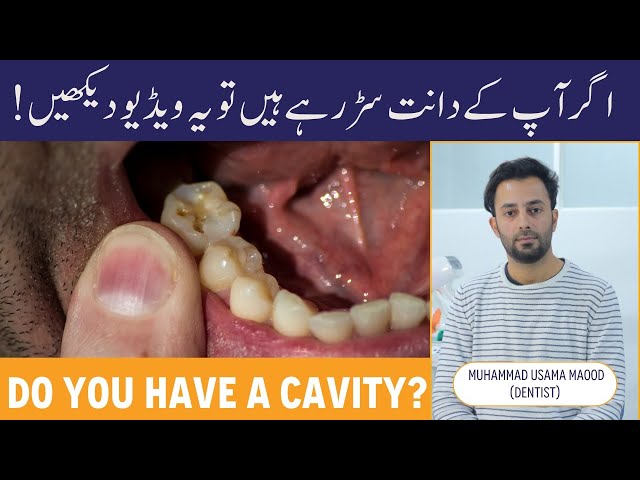 Dant Me Keede Ka Ilaj - What Is A Tooth Decay? - Dental Cavity Treatment - Danton Ke Sarne Ki Wajah!