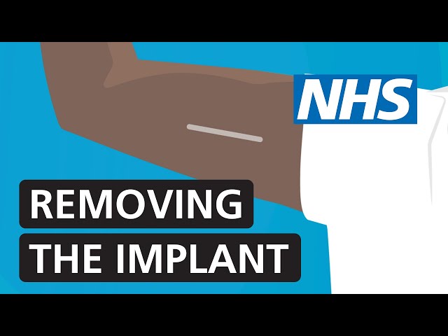 Removing the contraceptive implant | NHS