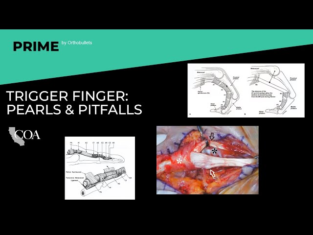 Trigger Finger: Pearls & Pifalls - Nikki Schroeder, MD