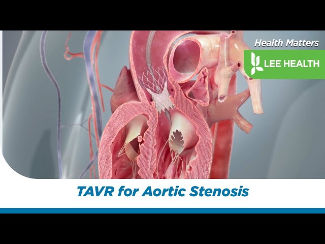 TAVR for Aortic Stenosis