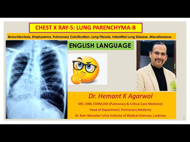 Radiology- Chest X Ray:5, (ENGLISH) Bronchiectasis, Emphysema, ILD, Pulmonary Edema...@Dr. Hemant