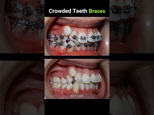 40 months for this braces. Crowded teeth #braces #orthodontist #dentist #dentistry