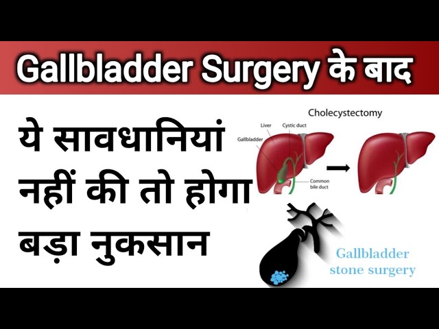 गॉल ब्लैडर सर्जरी के बाद घर पर देखभाल कैसे करें? | Precautions After Gallbladder Removal