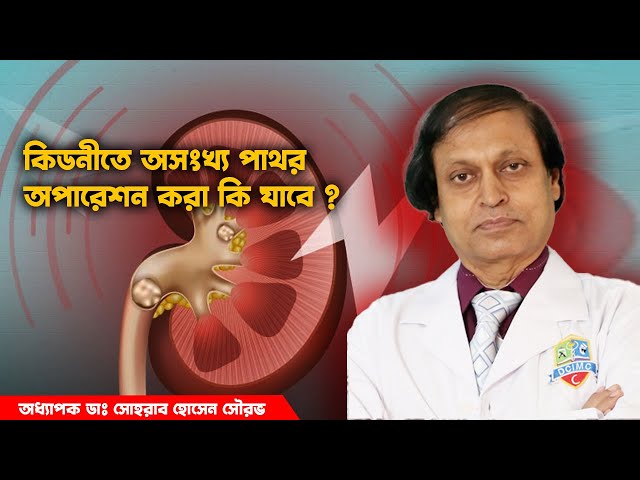 কিডনীতে অসংখ্য পাথর ! অপারেশন করা যাবে কি ?  Multiple kidney stones। হাসপাতাল