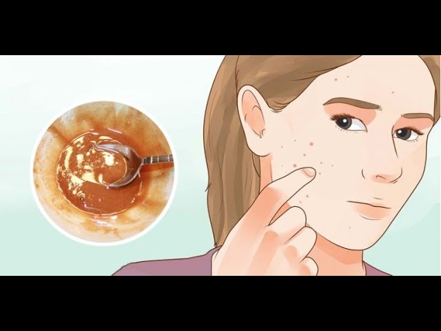 Use Apple Cider Vinegar And Baking Soda Mask To Remove Acne Scars And Stains In Your Face